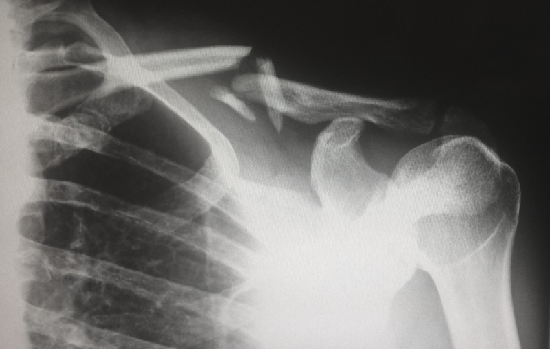 Avocat pour l'indemnisation d'une faute et d'une erreur médicale à Saint Chamas, Salon de Provence, Miramas et La Fare les Oliviers